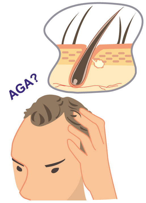 AGA治療はいつから始めるべき？～飲み薬のベストタイミング～