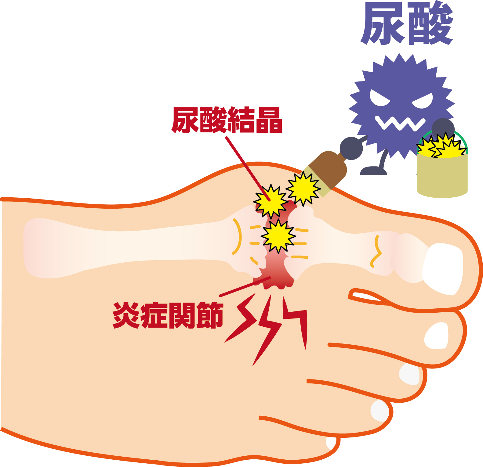 高尿酸血症の薬～ あなたに最適な治療を見つけるために ～